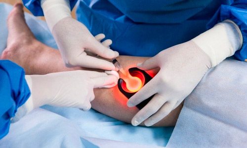 Трофические язвы на голени Трофические язвы на голени