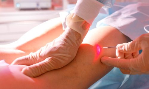 Венозная недостаточность