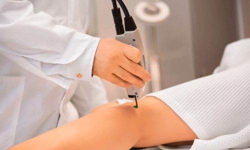 флебэктомия является оптимальным лечением флебэктомия является оптимальным лечением