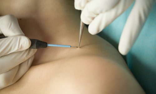 показания к удалению кондилом показания к удалению кондилом