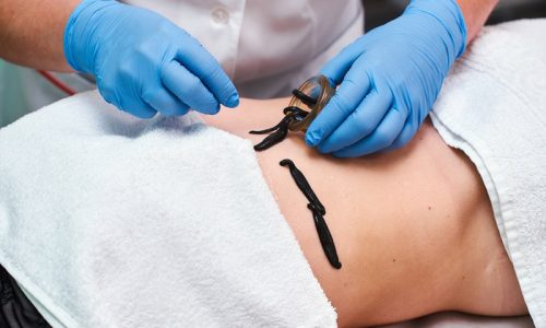 Гирудотерапия в гинекологии Гирудотерапия в гинекологии