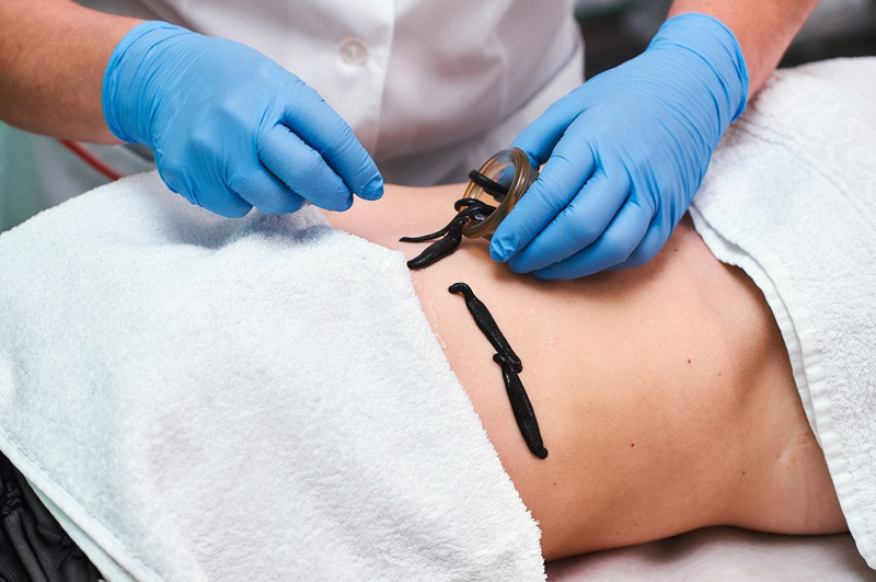 Гирудотерапия в гинекологии