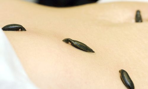 Гирудотерапия в клинике