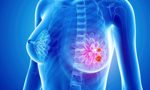 Операции при раке молочной железы Операции при раке молочной железы