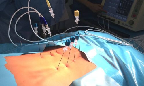 Процедура радиочастотной абляции нервов Процедура радиочастотной абляции нервов