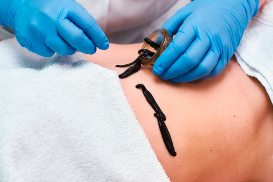 эффект от лечения пиявками 