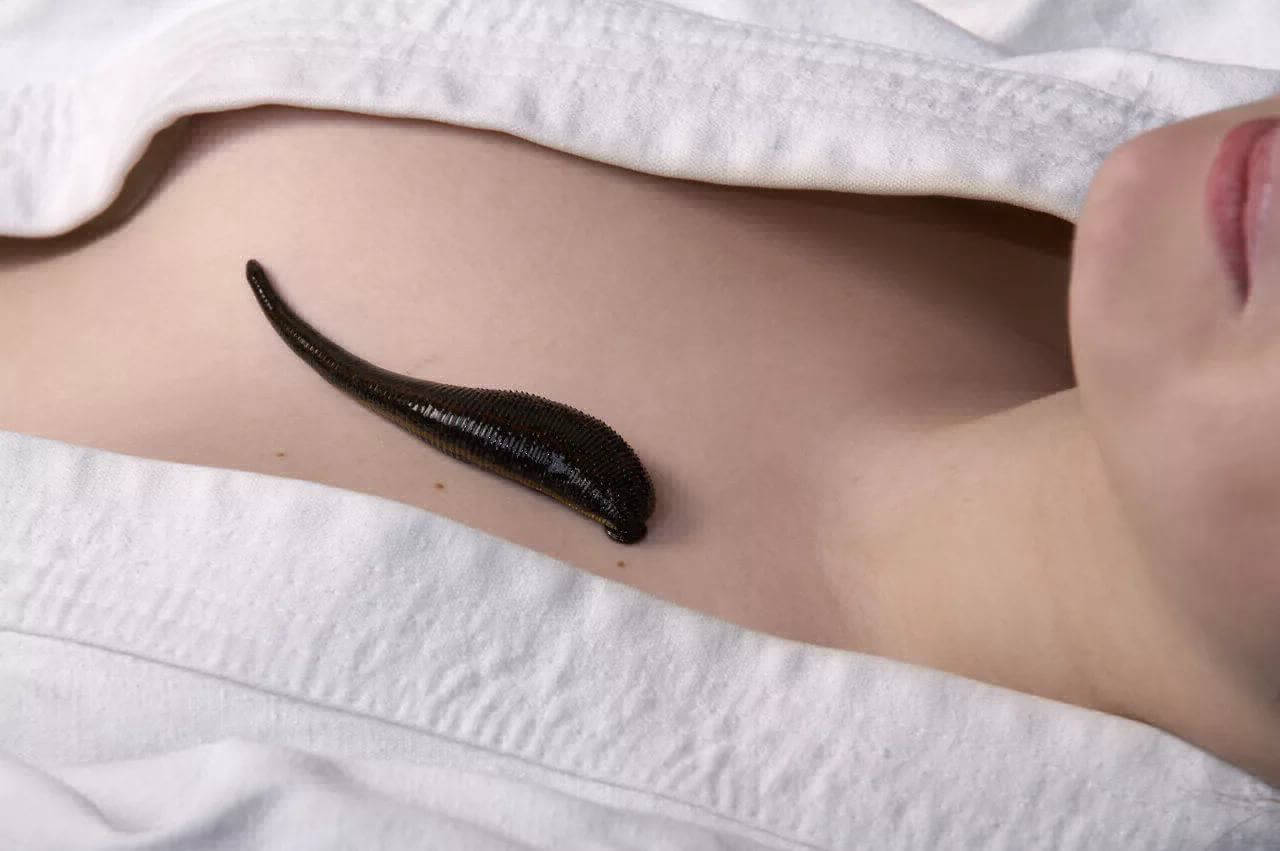 гирудотерапия при кардиологических заболеваниях