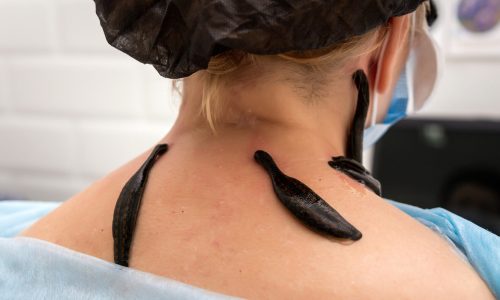 пиявки в пульмонологии