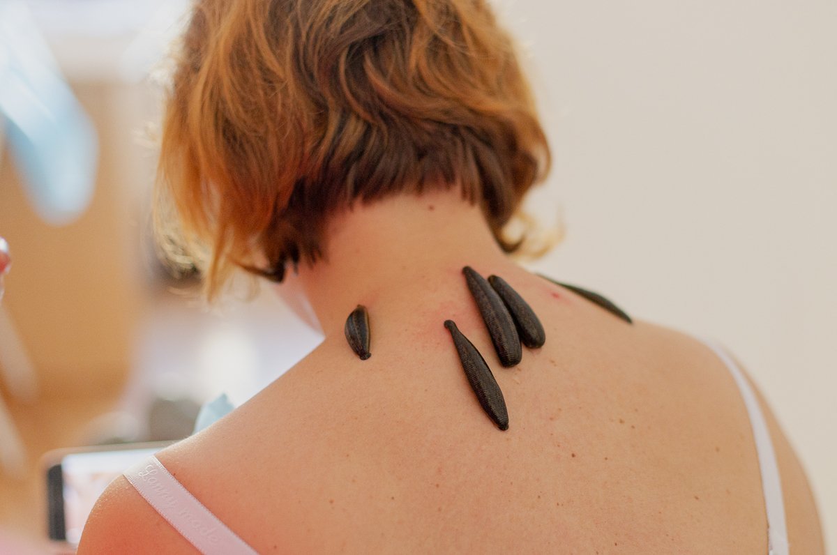 процедура гирудотерапии