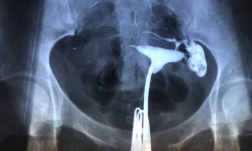 профессиональная гистеросальпинография