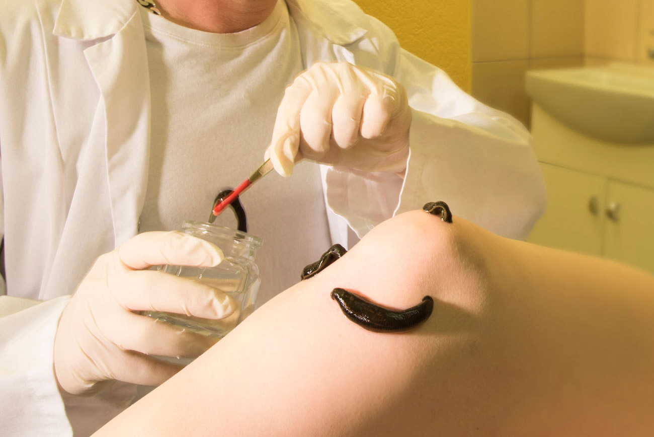 сеанс гирудотерапии