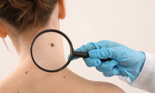 вмешательства по удалению меланомы