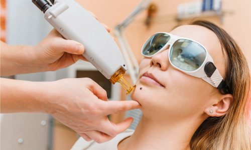 Эффективное и безопасное лазерное удаление пигментных пятен Эффективное и безопасное лазерное удаление пигментных пятен