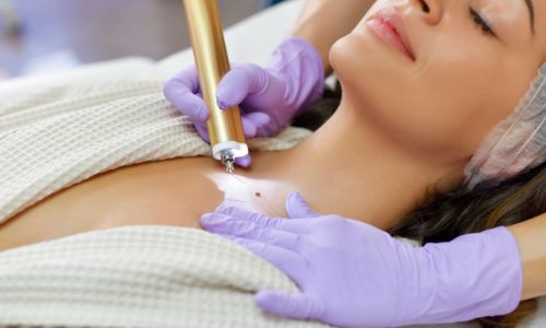 Эффективное лазерное удаление новообразований Эффективное лазерное удаление новообразований