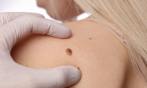 Качественное удаление невусов Качественное удаление невусов