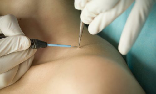 эффективная биопсия кожи