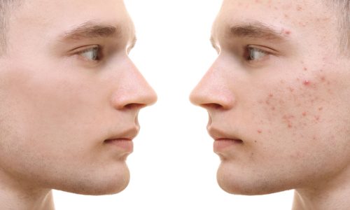 эффективное лечение акне
