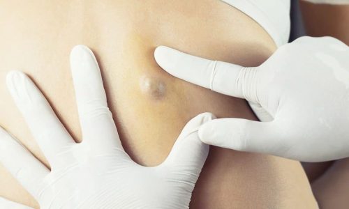 профессиональное лечение атеромы