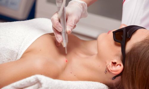 профессиональное удаление папиллом профессиональное удаление папиллом