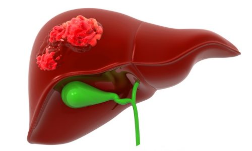 раке печени проводят хирурги раке печени проводят хирурги