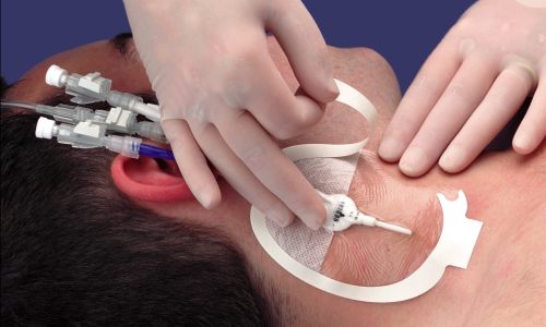 установки венозного катетера установки венозного катетера