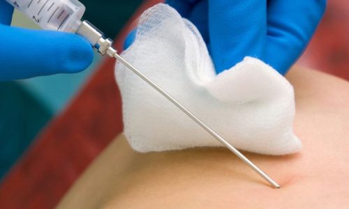 эффективный анализ пункция щитовидной железы эффективный анализ пункция щитовидной железы