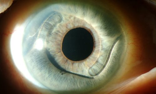 искусственный хрусталика искусственный хрусталика