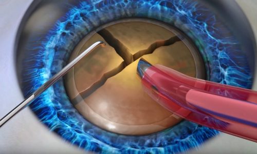 качественная Факоэмульсификация