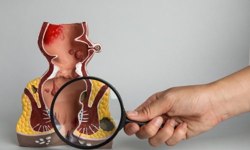 качественная Сфинктеропластика