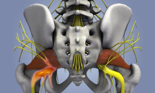 качественная Стимуляция крестцового нерва качественная Стимуляция крестцового нерва
