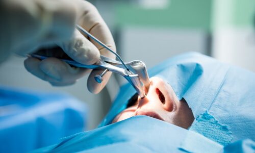 качественная аденотомия качественная аденотомия