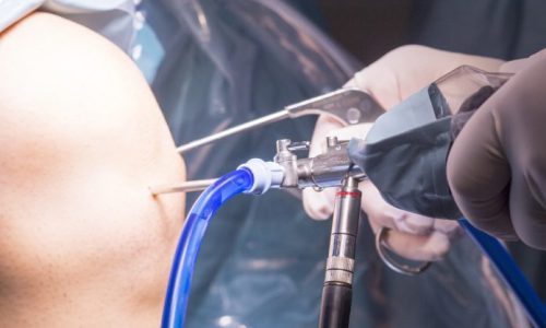 качественная Диагностическая артроскопия