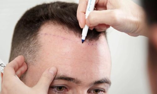 качественное Трансплантация волос методом FUE качественное Трансплантация волос методом FUE