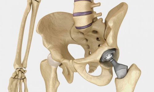 операция по эндопротезированию суставов операция по эндопротезированию суставов